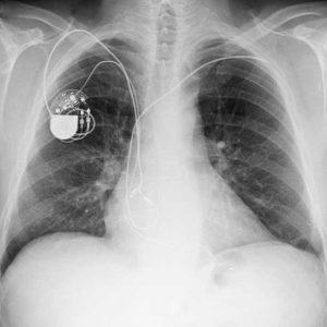 radiograph chest implanted cardiac pacemaker image